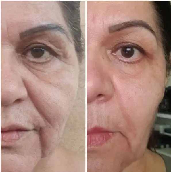 Resultado real - mulher 59 anos