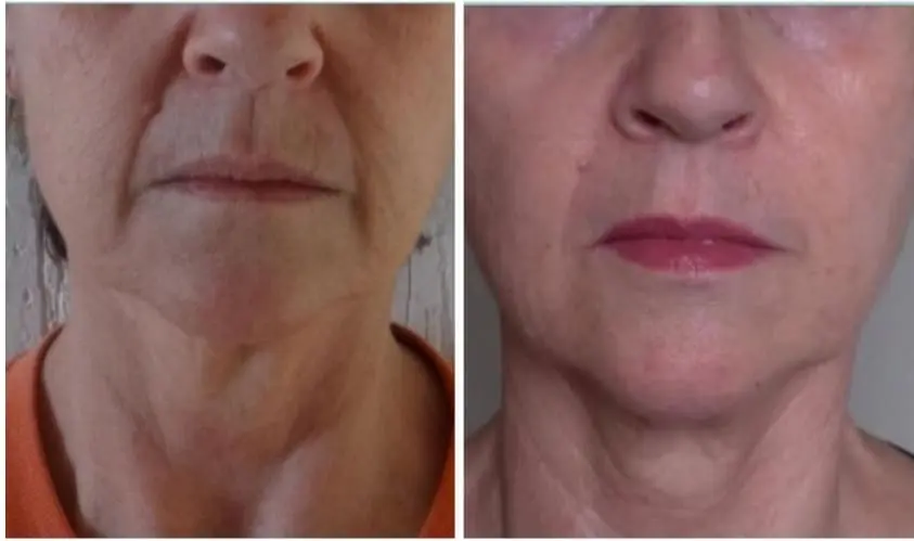 Antes e depois 62 anos